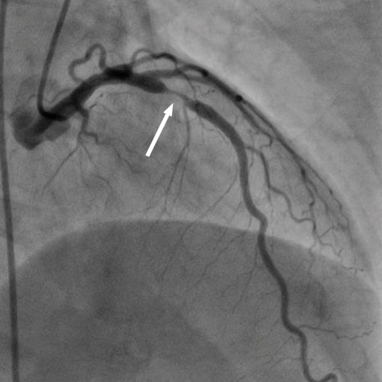 血管が狭くなっている左冠動脈の画像