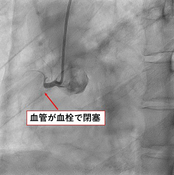 血管が血栓で閉塞している画像