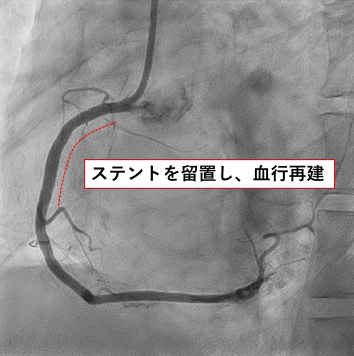 ステントを留置し、血行再建した画像