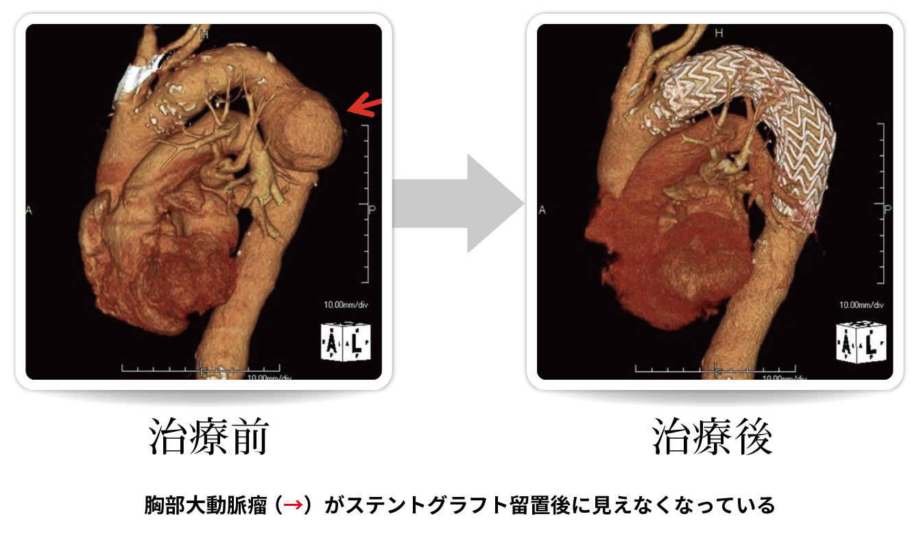 胸部大動脈瘤の治療例