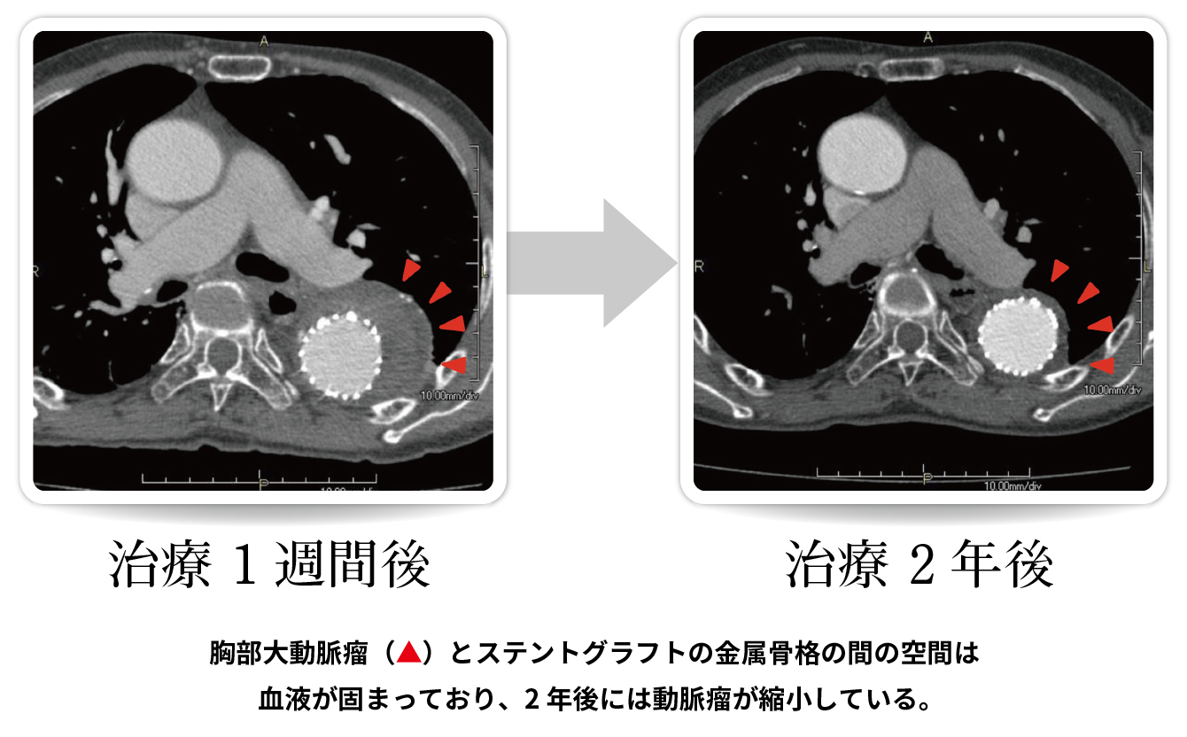 胸部大動脈瘤の治療例