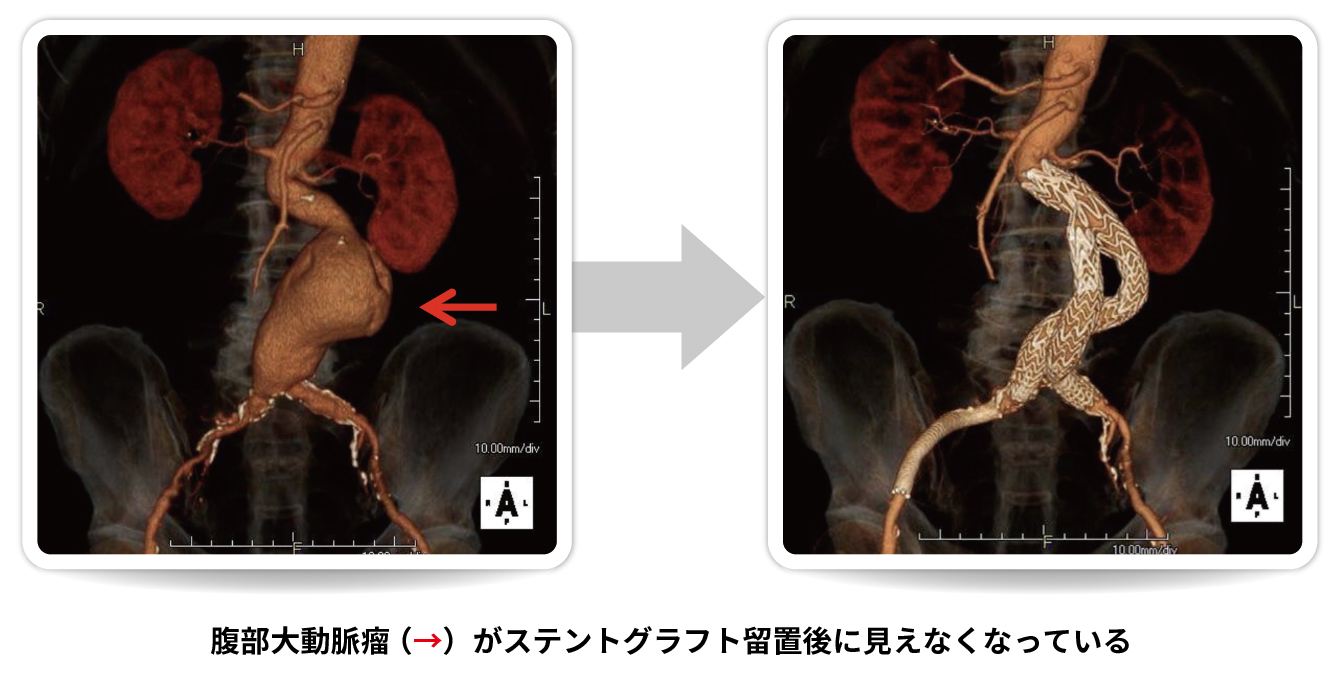 腹部大動脈瘤の治療例