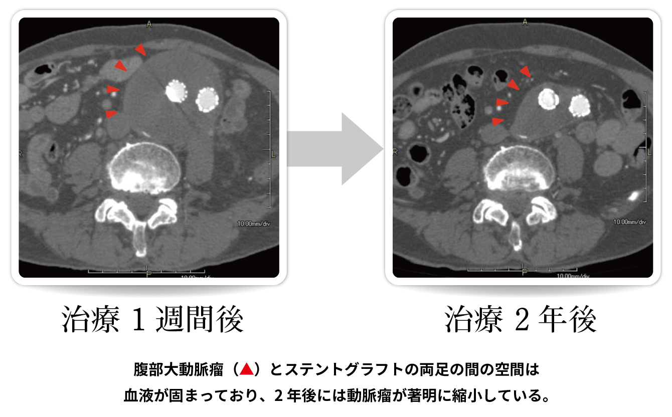 腹部大動脈瘤の治療例