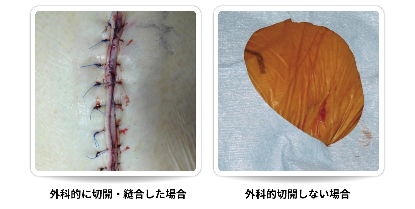 術後の鼠径部の傷