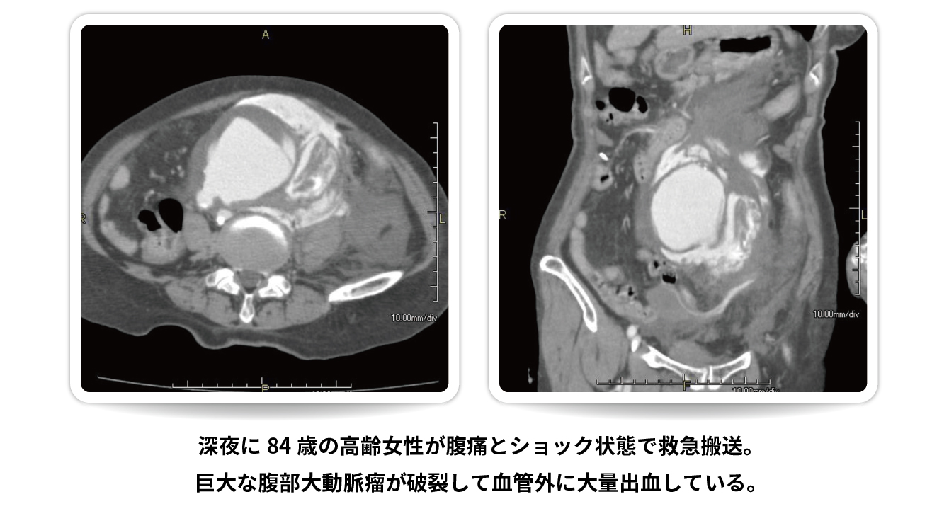 腹部大動脈瘤破裂の治療例