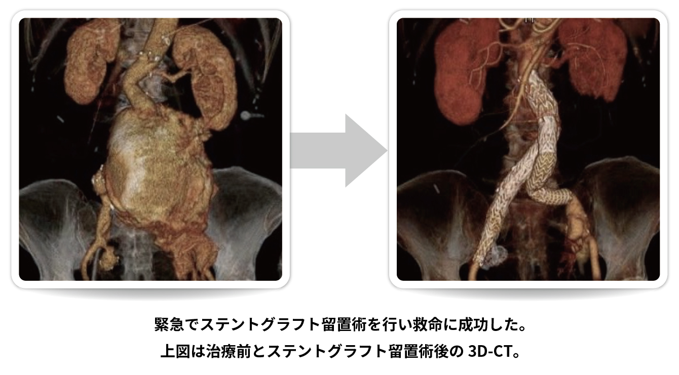 腹部大動脈瘤破裂の治療例