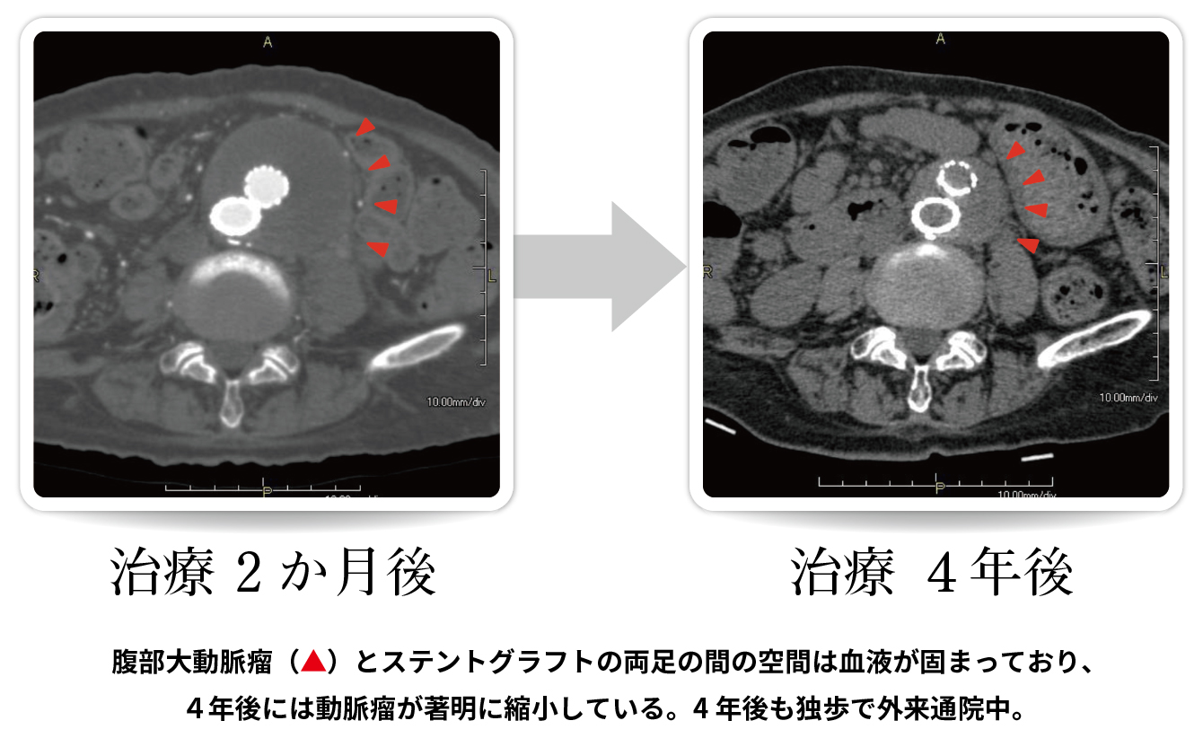 腹部大動脈瘤破裂の治療例