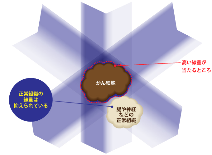 IMRTの照射法