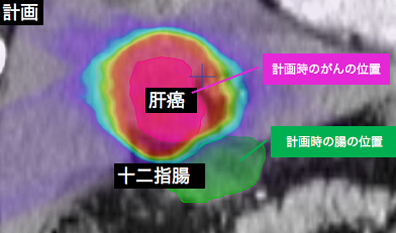 腸への高線量を抑えている