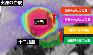 がんも腸も上方へ移動し腸が高線量域に含まれている