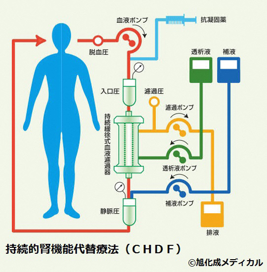 持続的腎機能代替療法の仕組みの解説画像