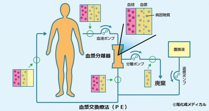 血漿交換の仕組みの解説画像