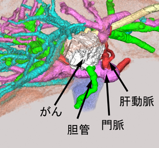 肝門部領域胆管がんの術前３D－CT画像の画像