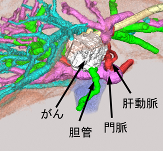 肝門部領域胆管がんの術前3D-CT画像の画像