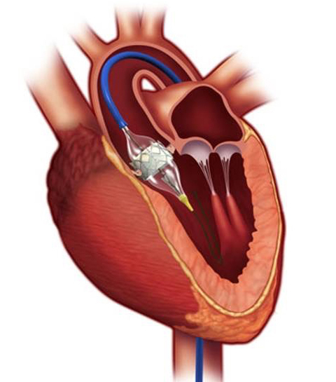 経大腿アプローチの画像