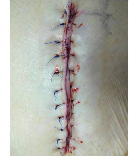 従来からの鼠径部を切開した場合の傷（5〜10cm程度）の画像